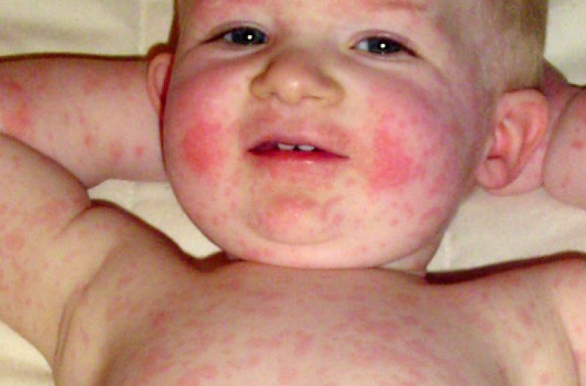  Első látásra ijesztő, de veszélytelen: ezt kell tudnod a lepkehimlőről